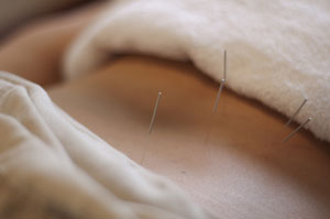 Acupuncture for Back Pain is Both Accepted and Effective